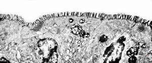 celiakia celiakia